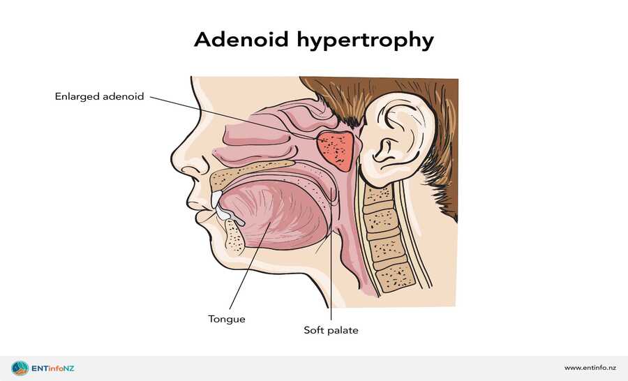 Large-adenoids-1-scaled-1.jpg