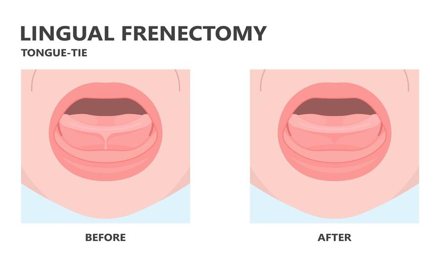 When-should-a-lingual-frenectomy-be-done-min-1.jpg