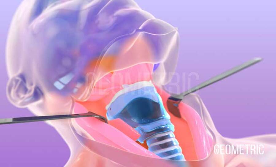 laryngectomy-animation-geometric-medical-03-1.jpg