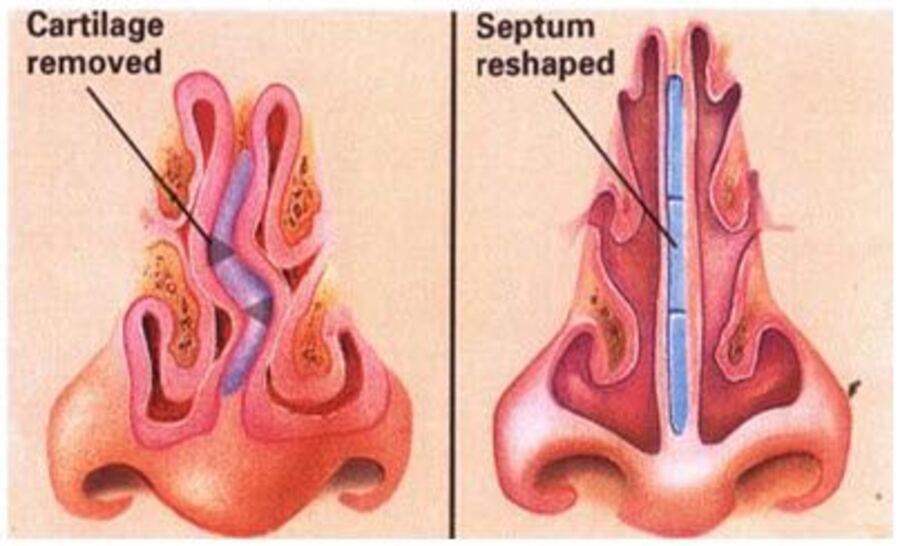 septoplasty-image-1.jpg