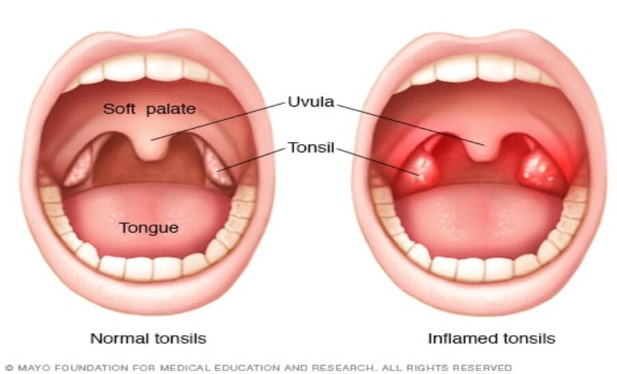 tonsils-1.jpeg